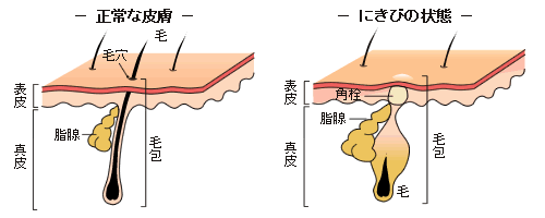 にきび