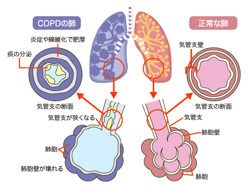 COPDの原因