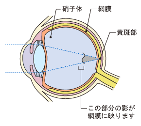 生理的飛蚊症