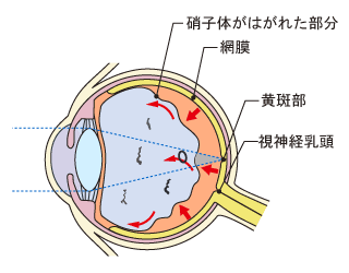 生理的飛蚊症　進行すると