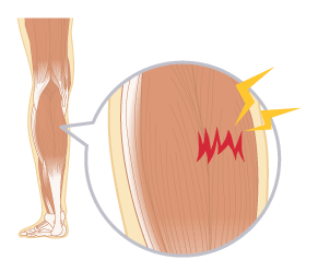 肉離れとは？