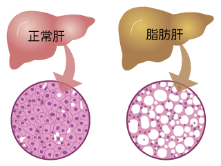 脂肪肝の肝臓