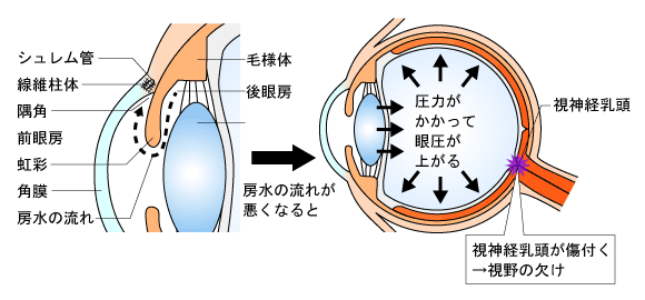 メカニズム（緑内障）