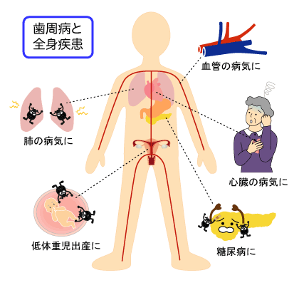 歯周病と疾患