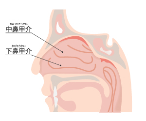 花粉症　鼻づまり　下鼻甲介と中鼻甲介の炎症